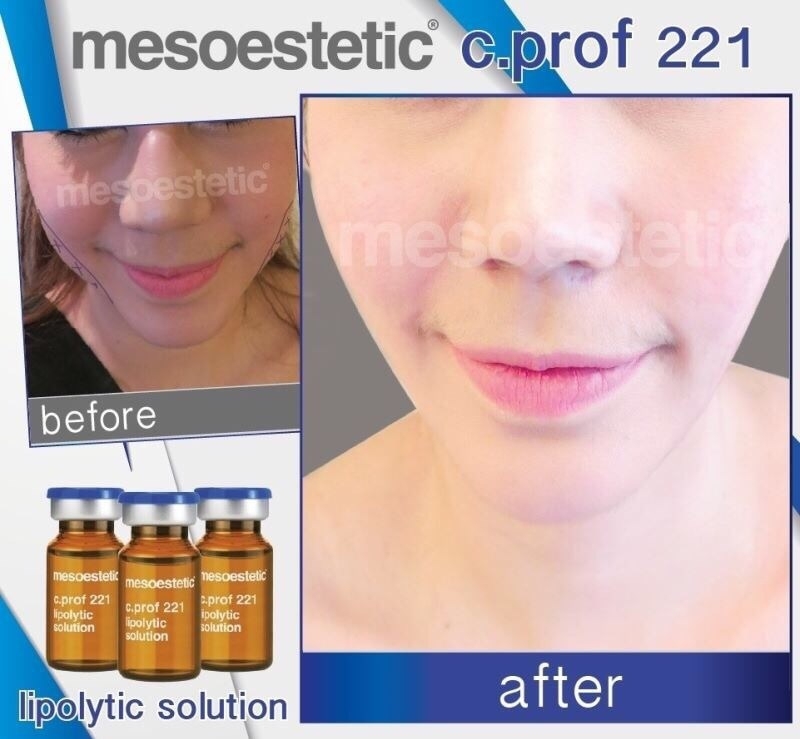 c.prof 221 Lipolytic solution เน้นสลายไขมัน