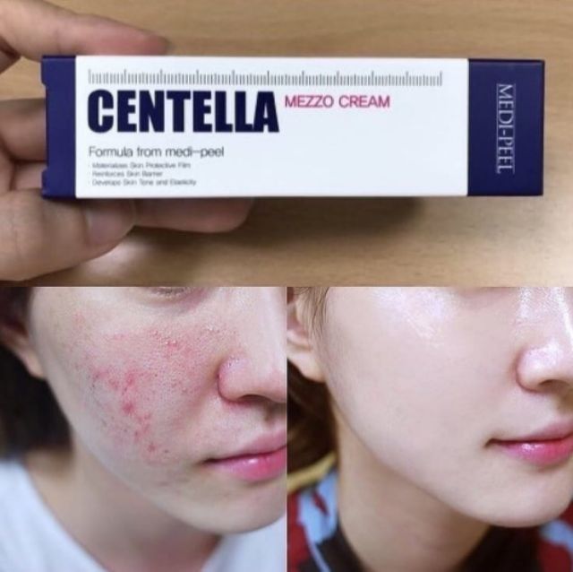 MEDI-PEELl Melanon X Centella Mezzo Cream Brightening Whitening Freckle 30ml. (Blue) ครีมที่ช่วยรักษารอยแผลเป็นรอยแดงจากสิวหลุมลึกจากสิวผื่นแพ้ต่างๆ ให้ดีขึ้น กระชับรูขุมขน ใช้สารสกัดจากธรรมชาติช่วยรักษาสิวได้ทุกชนิด ลดรอยสิว รอยดำ รอยแดง รอยแผล