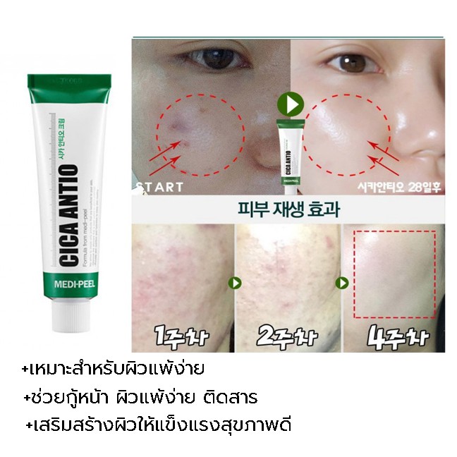 MEDI-PEEL Cica Antio Cream 30 ml. สุดยอดของเวชภัณฑ์สำอางเข้มข้นบำรุงผิวหน้าเหมาะสำหรับผิวเป็นสิวรักษา เห็นผลภายใน 7วัน หลอดสีเขียวเน้นรักษารอยที่เกิดจากสิวโดยเฉพาะ ฟื้นฟูกู้หน้าพัง